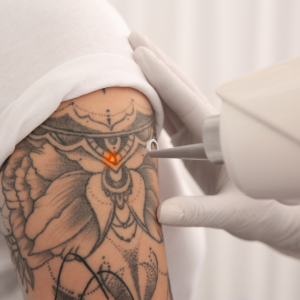 tattoo-removal-in-amsterdam