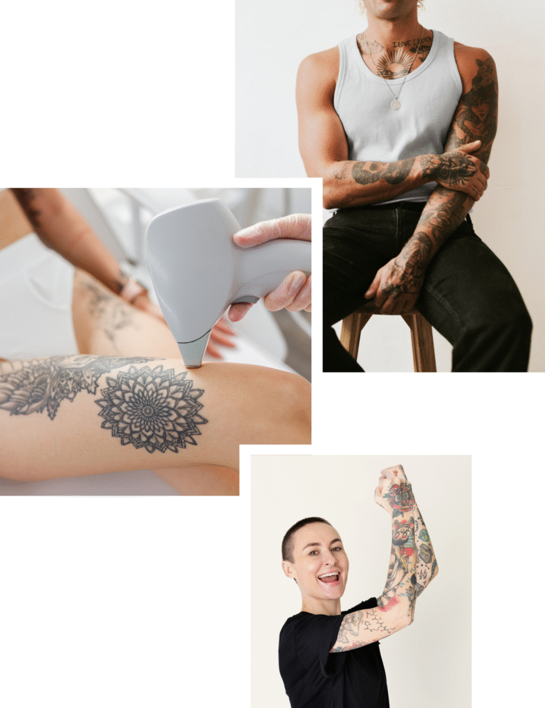 Tattoo Removal