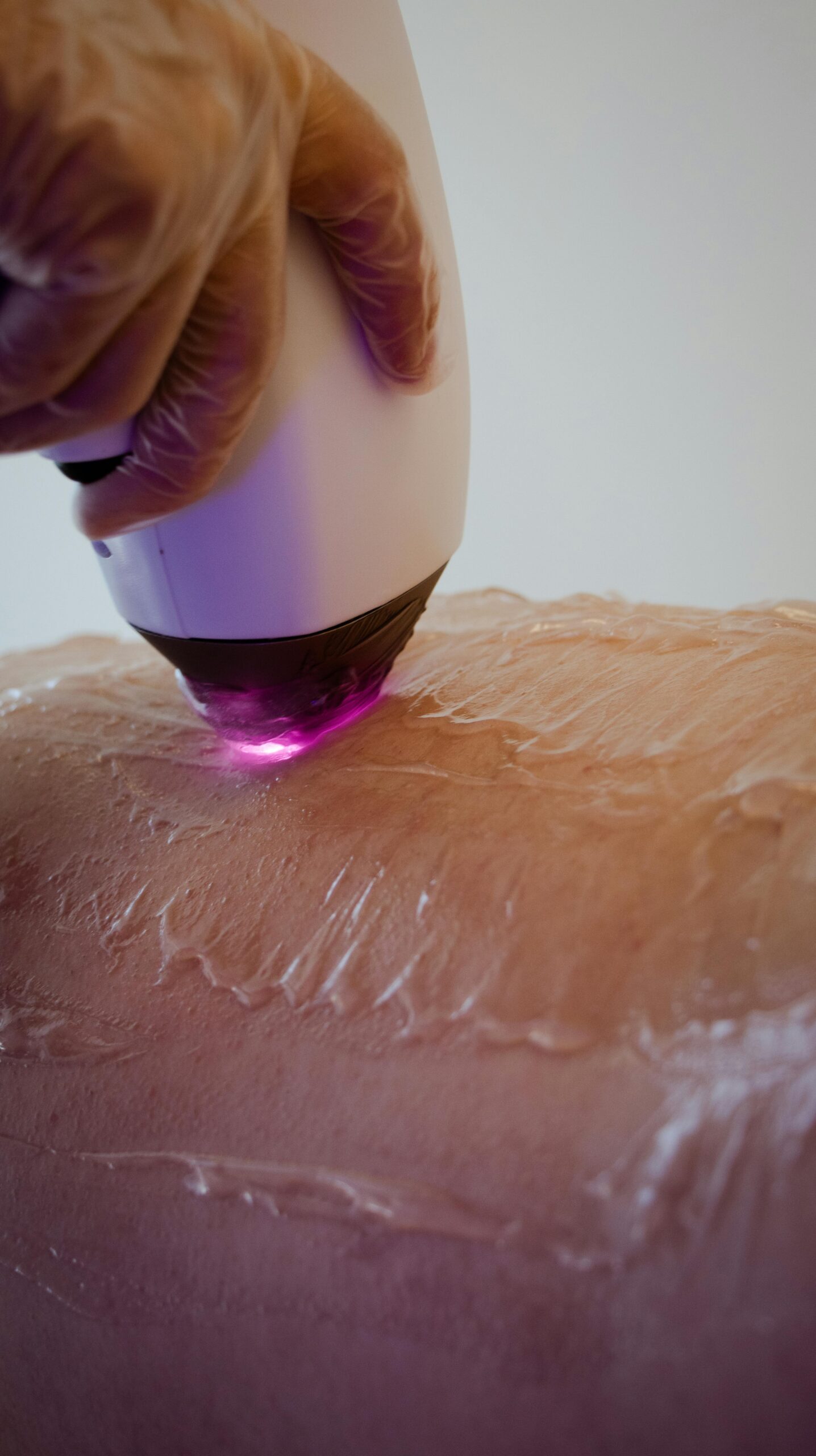 During a laser waxing procedure, highlighting the precision and care involved.