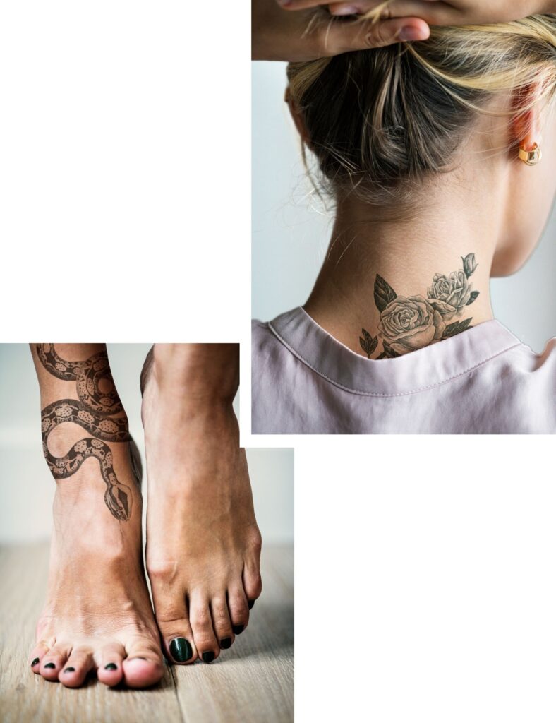Tattoo Removal in Amsterdam