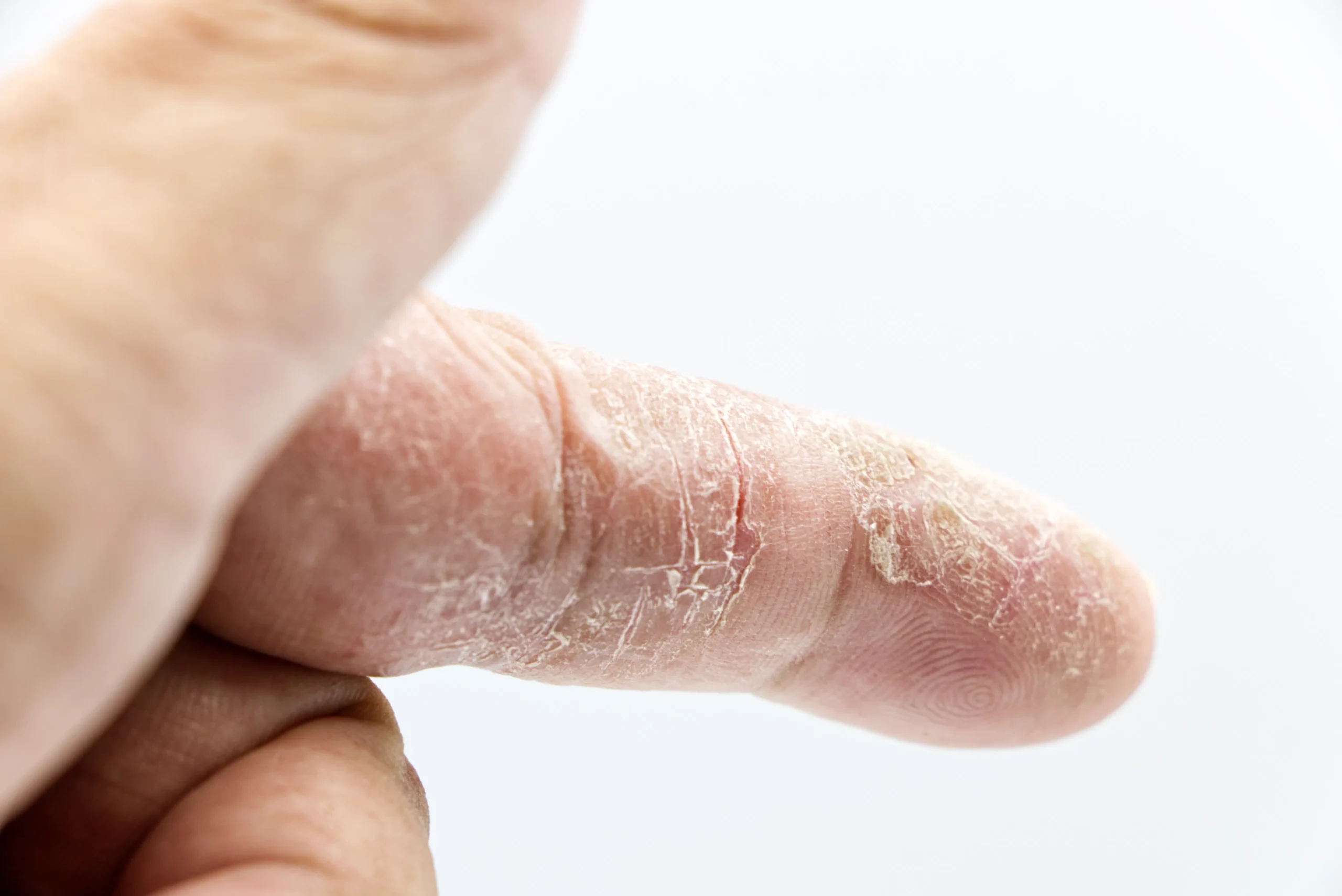 Close-up of dry, irritated skin requiring professional beauty services in Amsterdam.