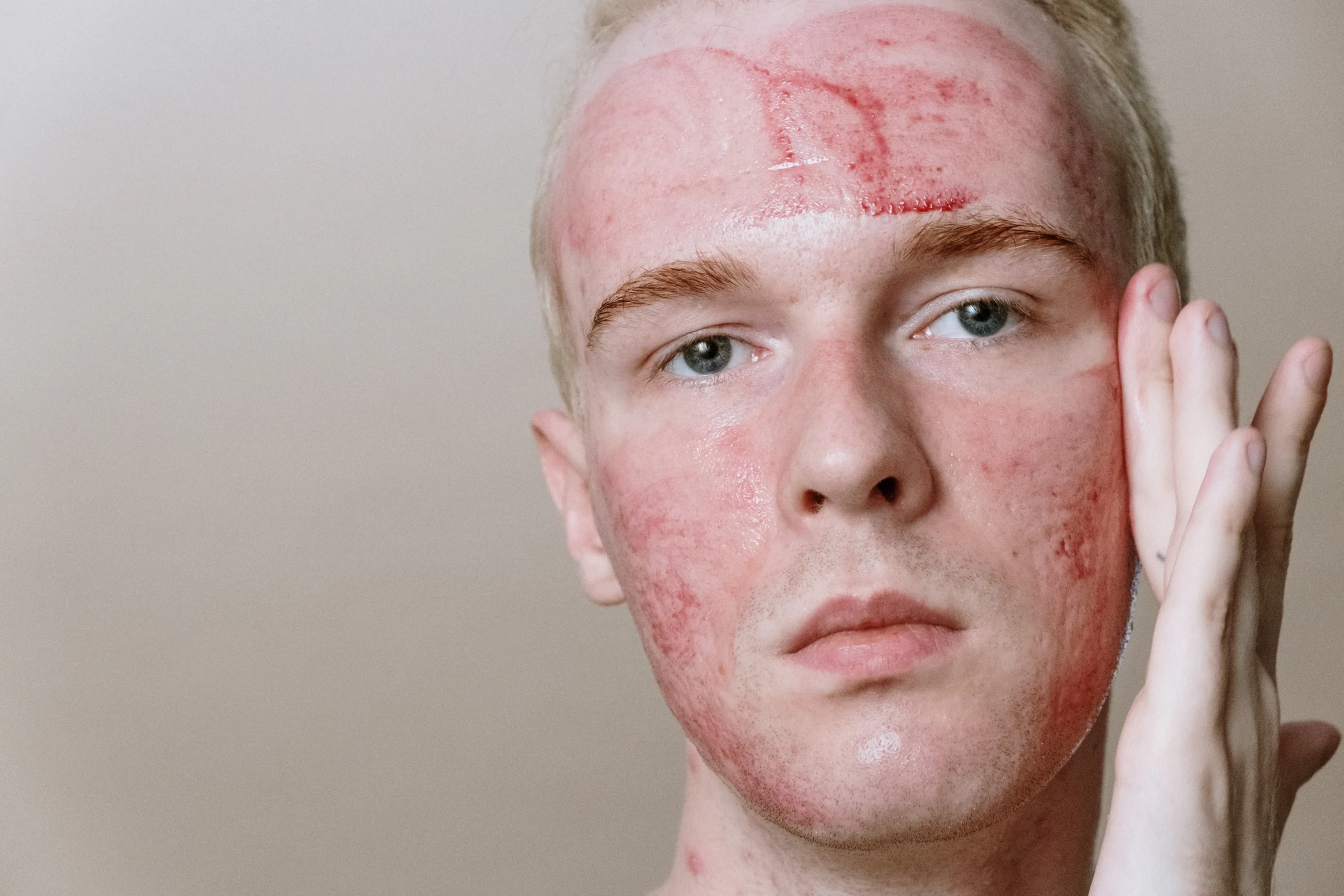 sensitive skin facial redness