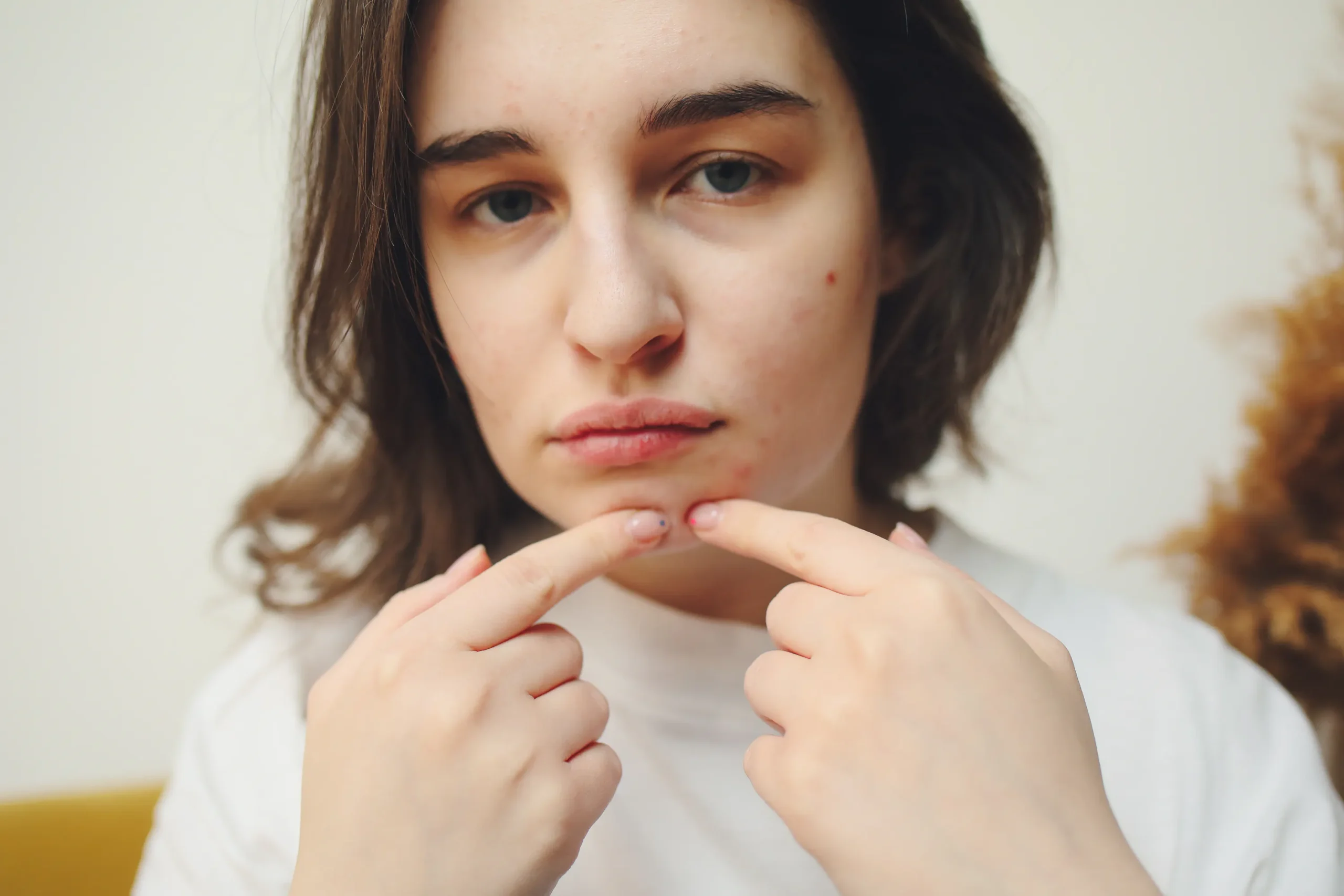 Young woman with acne on her chin, illustrating skin concerns solved by carbon laser peel results.