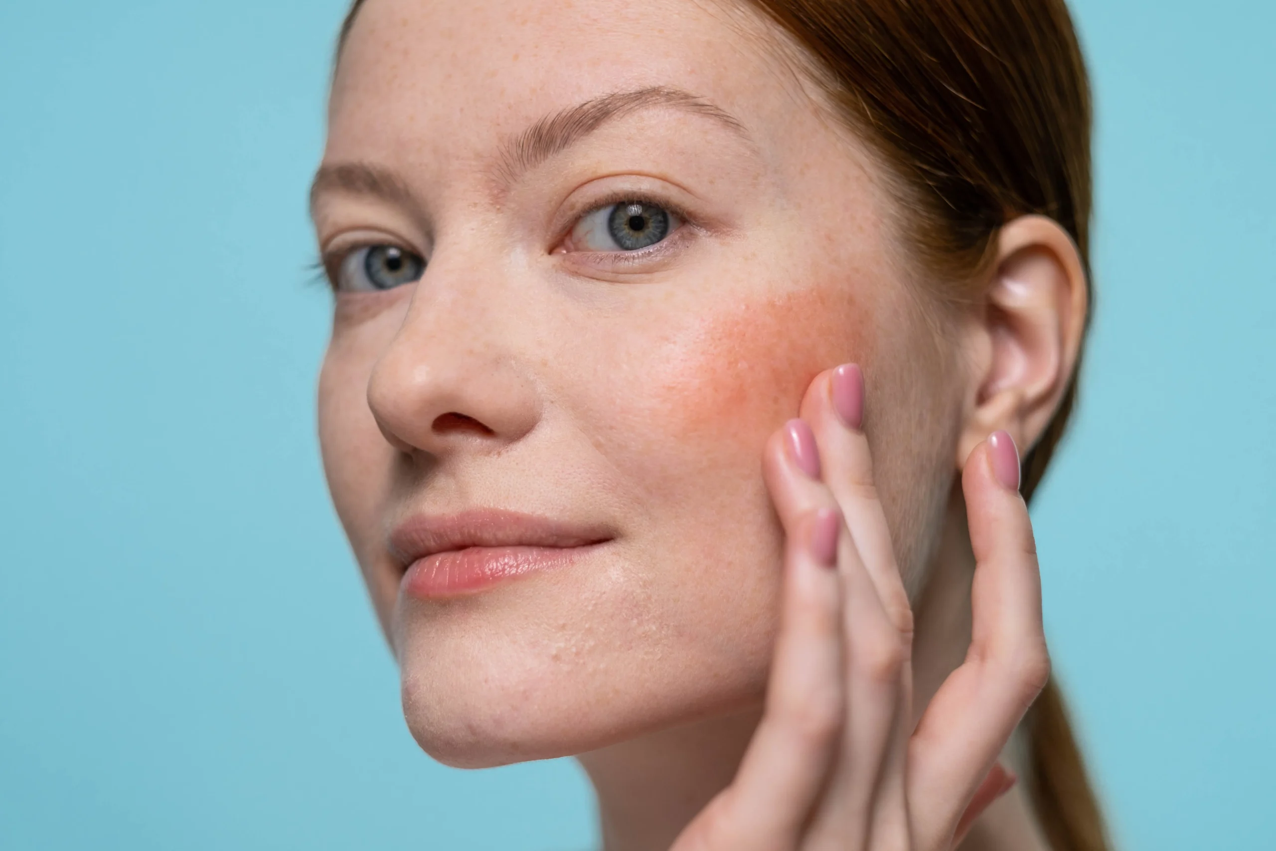 Close-up of a fair-skinned woman with red hair gently touching her cheek, which shows a red patch, representing a common skin concern that a carbon peel facial can address.